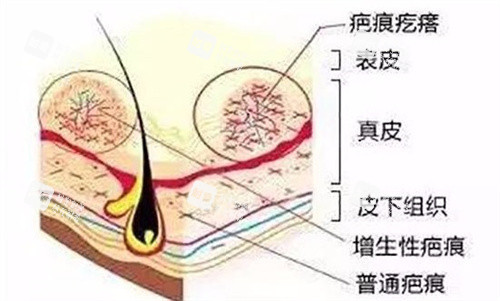 疤痕疙瘩皮肤解析图 疤痕疙瘩皮肤解析图