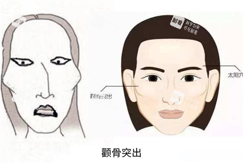颧骨突出演示动画图 颧骨突出演示动画图