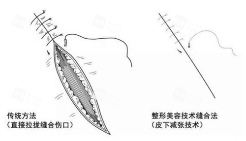 超减张精细缝合和传统缝合的区别图片 超减张精细缝合和传统缝合的区别图片