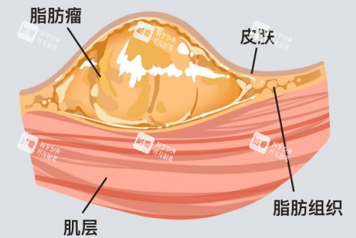 脂肪瘤所在皮肤层面示意图 脂肪瘤所在皮肤层面示意图