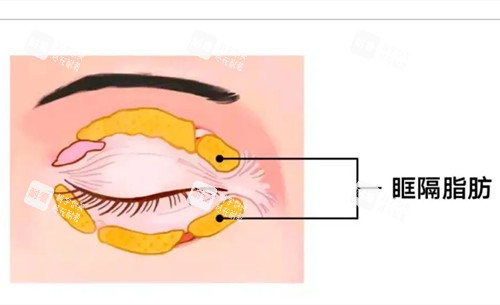 眼周眶隔脂肪卡通示意图 眼周眶隔脂肪卡通示意图