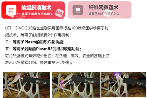 维密金雕原理介绍