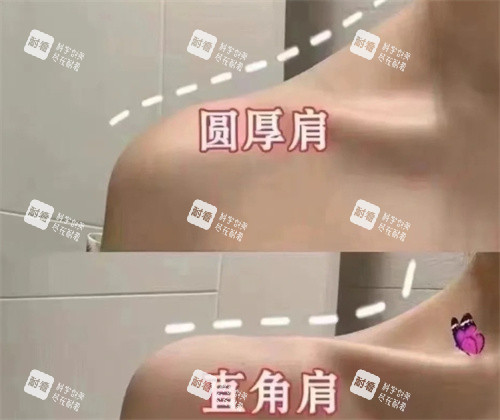 圆肩膀和直角肩对比 圆肩膀和直角肩对比