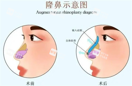 隆鼻前后对比 隆鼻前后对比