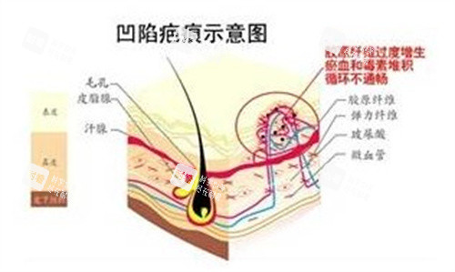 凹陷疤痕 凹陷疤痕
