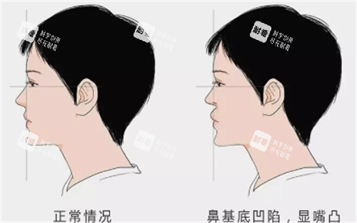 鼻基底凹陷对面部的影响图解 鼻基底凹陷对面部的影响图解