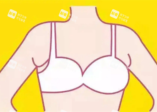 副乳位置卡通示意图 (2) 副乳位置卡通示意图 (2)