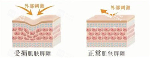 皮肤屏障受损 皮肤屏障受损