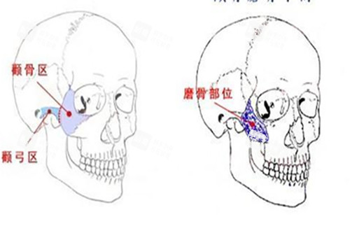 颧骨磨骨手术示意图.jpg