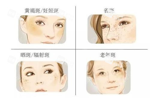 雀斑的种类 雀斑的种类