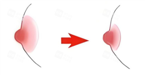 乳晕缩小术对比图 乳晕缩小术对比图