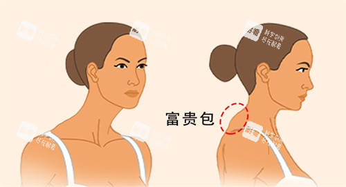 富贵包消除前后对比