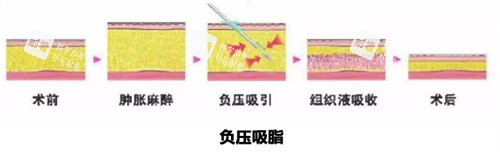 抽脂手术方式动画图 抽脂手术方式动画图