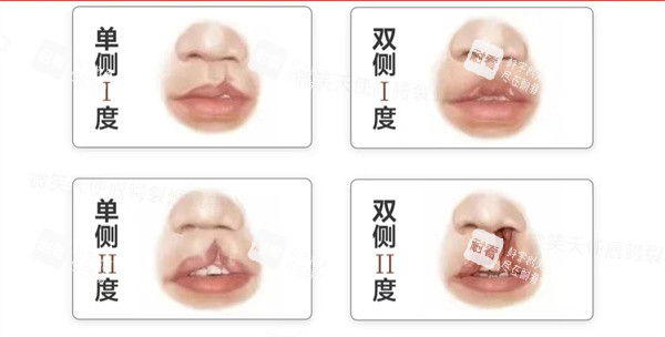 唇裂 唇裂