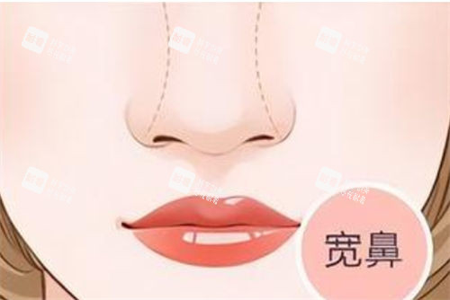 宽鼻形态展示图 宽鼻形态展示图