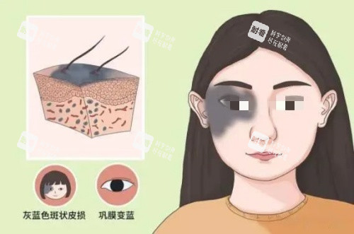 真皮斑形态示意图.jpg 真皮斑形态示意图.jpg