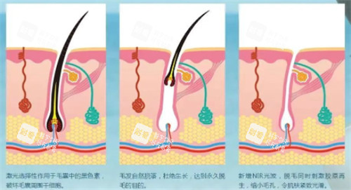 光子脱毛前后变化 光子脱毛前后变化