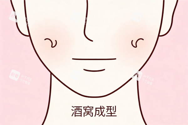 酒窝成形术卡通图展示