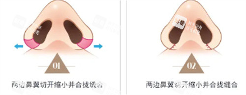鼻翼手术动画照片 鼻翼手术动画照片
