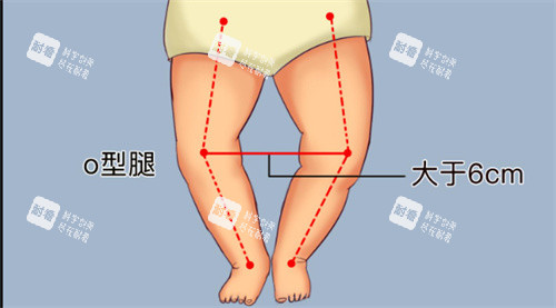 o型腿 o型腿