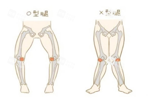 腿型矫正图示 腿型矫正图示