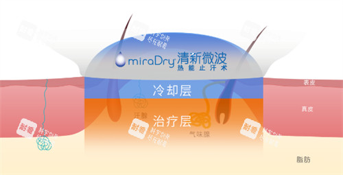 miraDry清新微波作用层次 miraDry清新微波作用层次