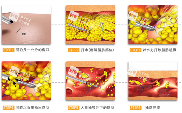 吸脂过程详细图解 吸脂过程详细图解
