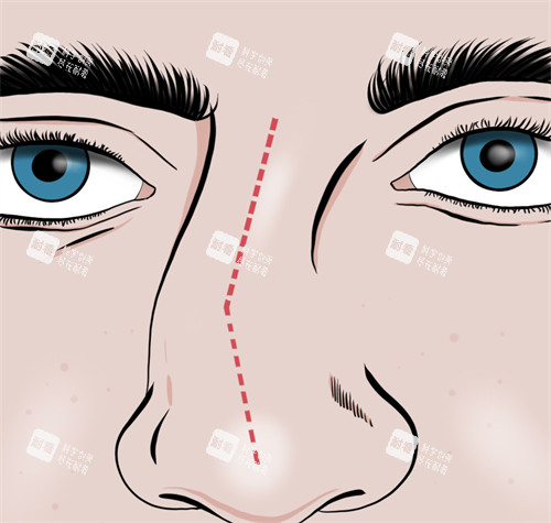 歪鼻对五官不友好
