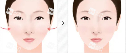 颧骨整形对比图
