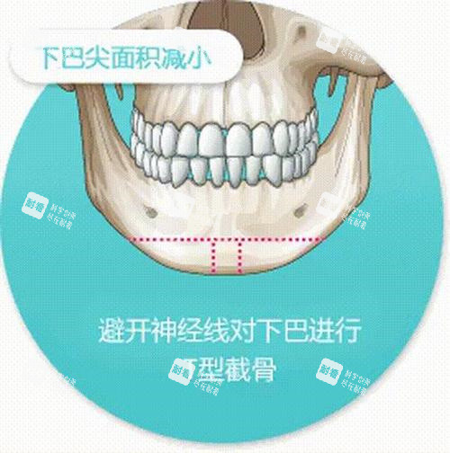 T型截骨术手术切口线演示图 T型截骨术手术切口线演示图