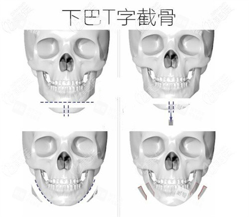 T型截骨术手术步骤动画图 T型截骨术手术步骤动画图