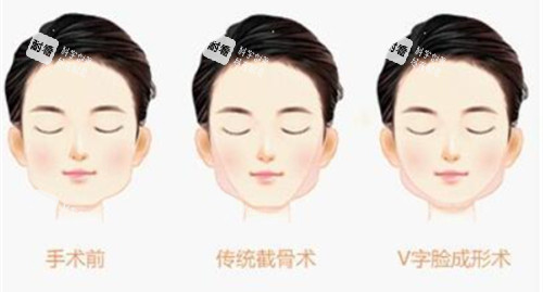 下巴宽大手术后效果动画图 下巴宽大手术后效果动画图