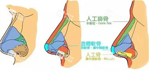 隆鼻手术对比 隆鼻手术对比