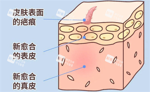 疤痕的形成过程 疤痕的形成过程