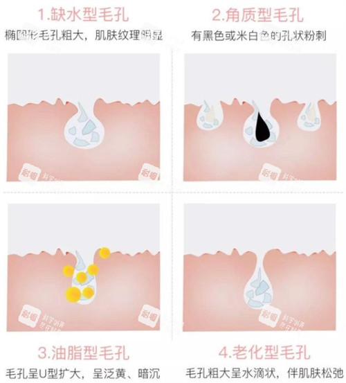 不同问题的毛孔 不同问题的毛孔