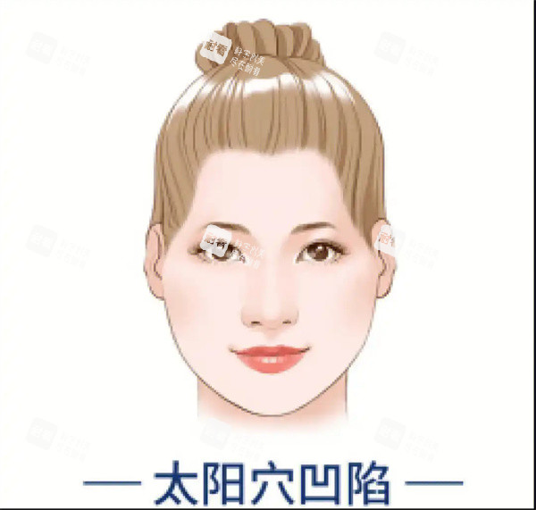 太阳穴凹陷 太阳穴凹陷