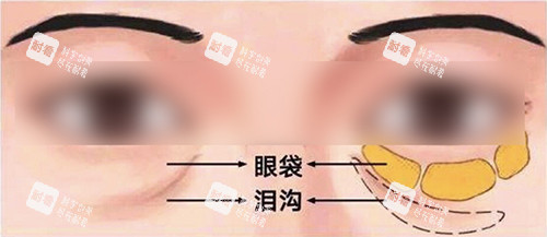 泪沟 泪沟
