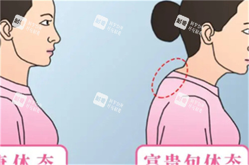 富贵包的体态图解 富贵包的体态图解
