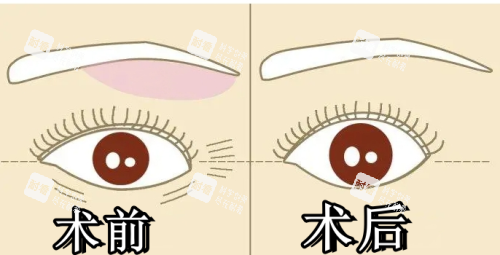 提眉术前术后对比图 提眉术前术后对比图
