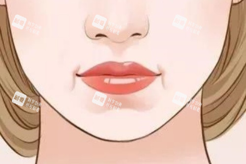 嘴角木偶纹图片展示 嘴角木偶纹图片展示