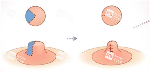 乳头缩小术 乳头缩小术