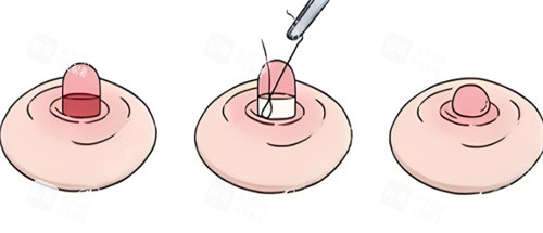 乳头缩小手术 乳头缩小手术