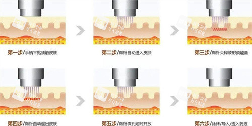 黄金微针