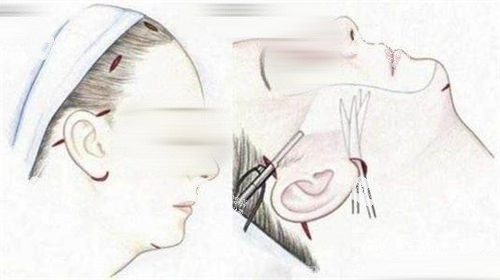 拉皮手术画线手术过程展示图.jpg 拉皮手术画线手术过程展示图.jpg