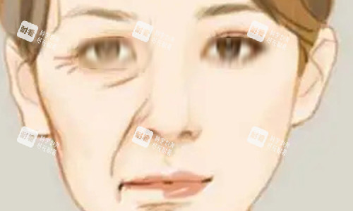 拉皮手术的对比动画图 拉皮手术的对比动画图