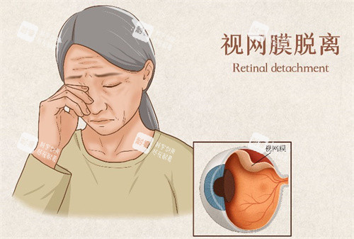 视网膜脱落的症状