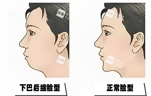 下巴后缩与正常脸型对比动画图
