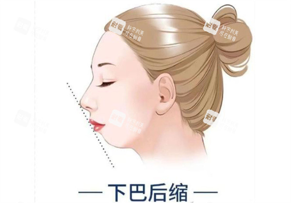 下巴后缩卡通图片