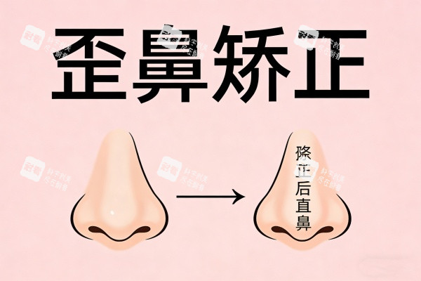 歪鼻矫正卡通图展示