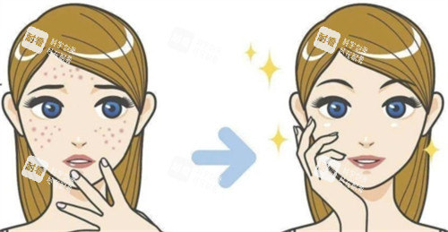 祛痘治疗前后对比